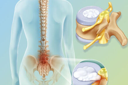 Natural remedy for herniated discs with chiropractic!￼